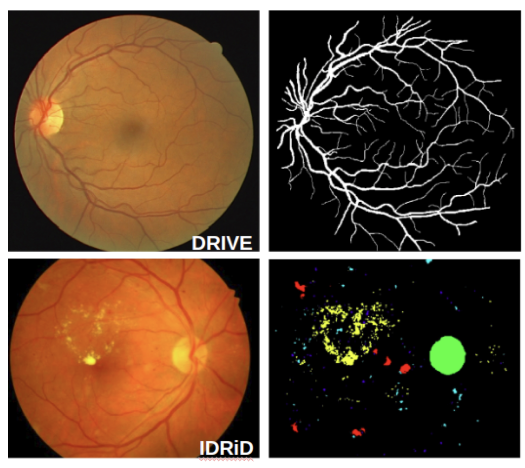 Learning with Multitask Adversaries using Weakly Labelled Data for Semantic Segmentation in Retinal Images